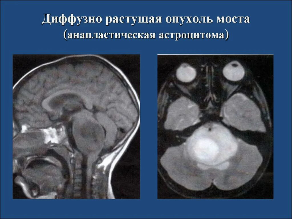 Диффузная глиома ствола головного. Астроцитома головного мозга в стволе. Глиома ствола головного мозга. Диффузная астроцитома