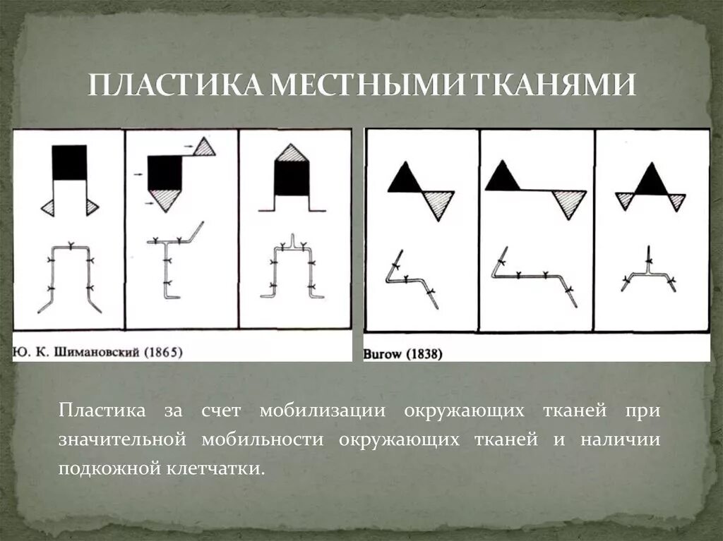 Пластика местными тканями члх. Пластика раны местными тканями. Пластика круглого дефекта кожи местными тканями. Кожная пластика расщепленным кожным лоскутом. Виды местной пластики.