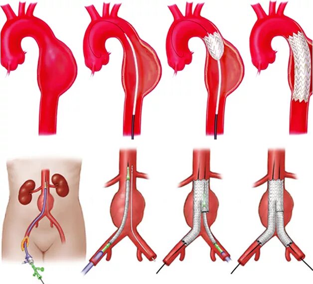 Аневризма брюшной аорты стентирование. Аневризма брюшной аорты по Дебейки. Саккулярная аневризма. Эндоваскулярная операция аневризмы грудной аорты. Аневризма восходящей аорты операция