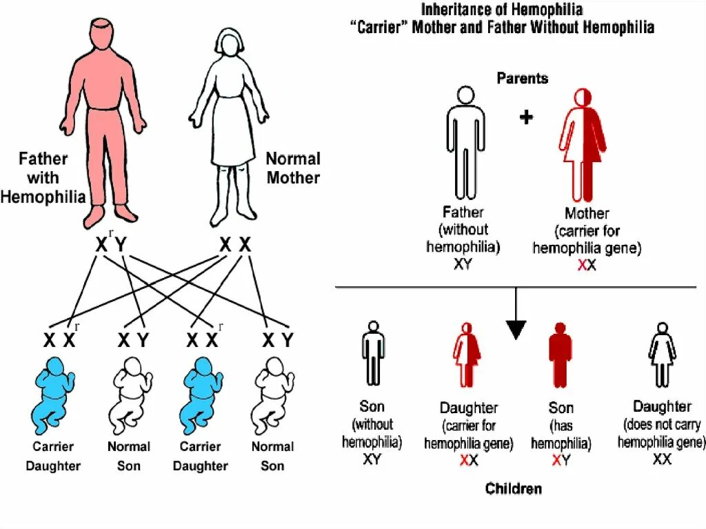 Схема наследования гемофилии. Как передается гемофилия. Схема наследования гемофилии у человека.