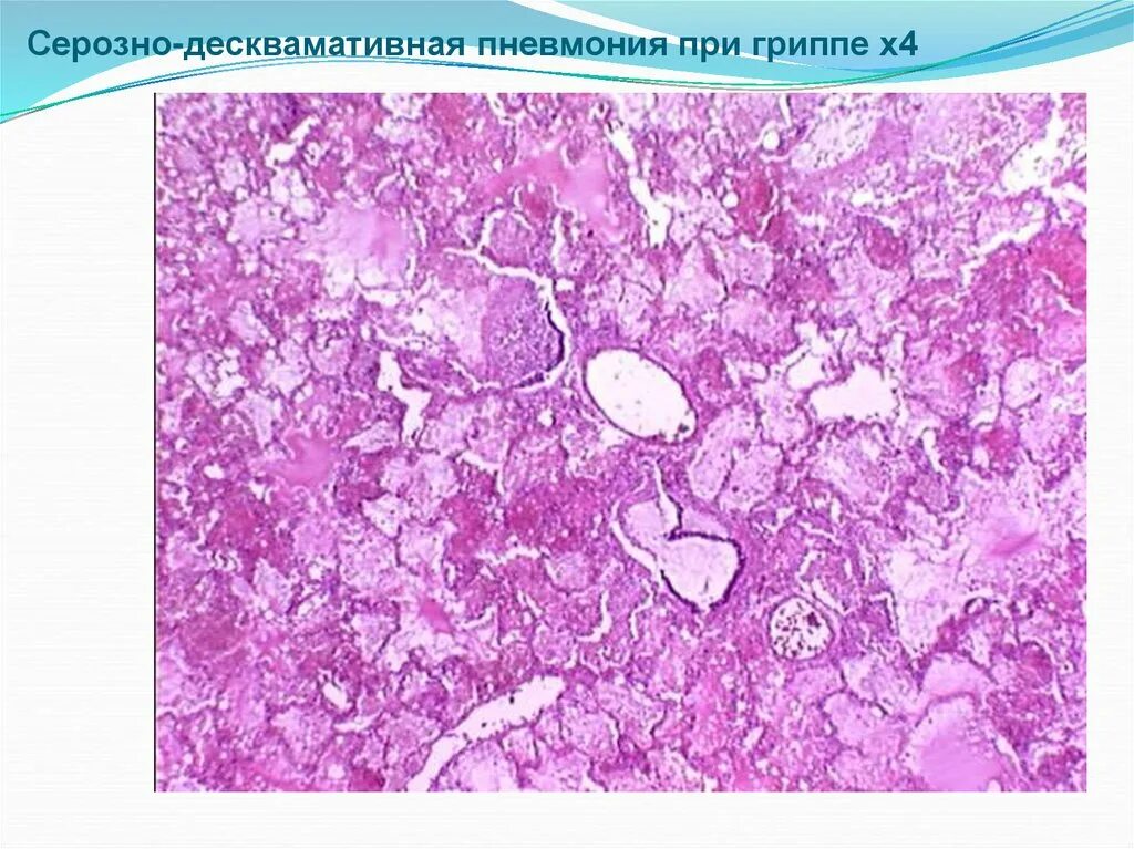 Коревая пневмония гистология. Серозно геморрагическая пневмония. Серозная пневмония патанатомия. Серозная пневмония гистология.