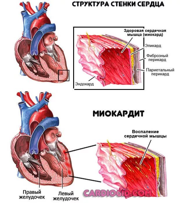 Миокардит левого желудочка. Воспалительные заболевания сердца перикардит. Миокардит митрального клапана. Миокардит – воспалительное поражение сердечной.
