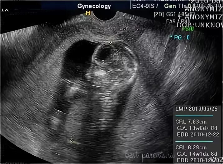 Сердцебиение 14 недель. УЗИ 14 недель беременности. Плацента на 14 неделе беременности.