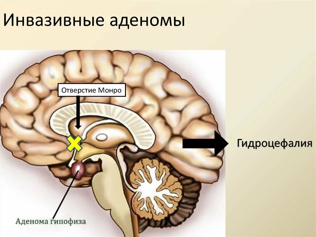 Пролактинома головного мозга. Пролактин микроаденома