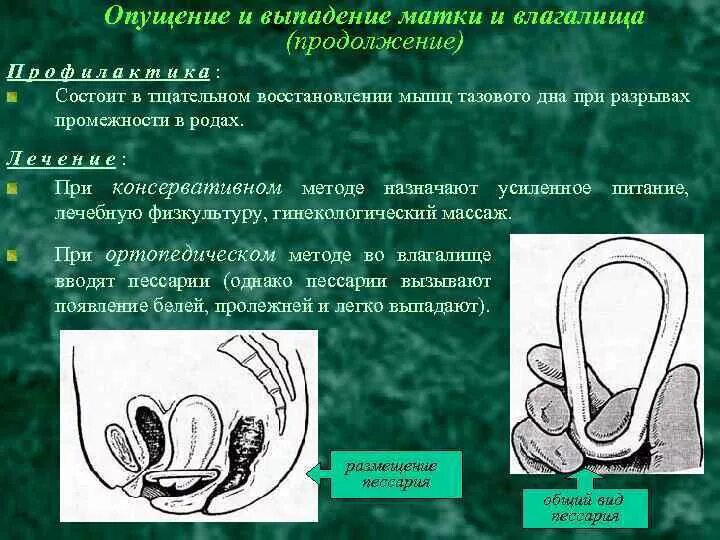 Ощущение выпадение матки как это наглядный пример Опущение матки симптомы лечение последствия найдено 77 картинок