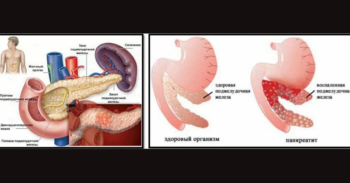 Может ли при воспалении поджелудочной. Острый панкреатит поджелудочной железы. Панкреатит симптомы панкреатин. Поджелудочная железа острый и хронический панкреатит. Панкреатит фотографии поджелудочной железы.