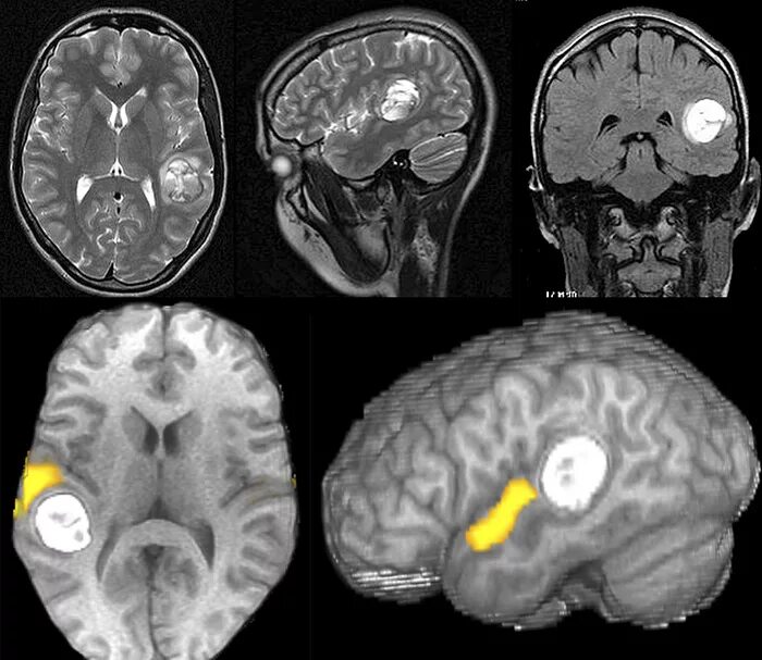 Мрт с контрастом головного. Функциональная магнитно-резонансная томография головного мозга. Магниторезонансная томография головного мозга. Функциональная мрт (ФМРТ). Мигрень на мрт головного мозга.