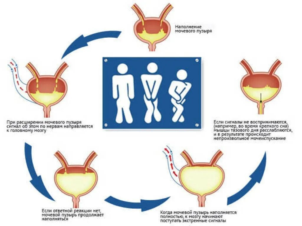 После мочевого. Недержание мочи. Причины недержания мочи. Мочевой пузырь недержание. Степени наполнения мочевого пузыря.