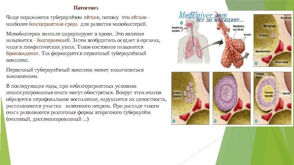 Без перифокальной реакции. Форма воспаления при туберкулезе. Патогенез туберкулеза. Патогенез туберкулеза легких. Патогенез первичного туберкулеза лёгких.