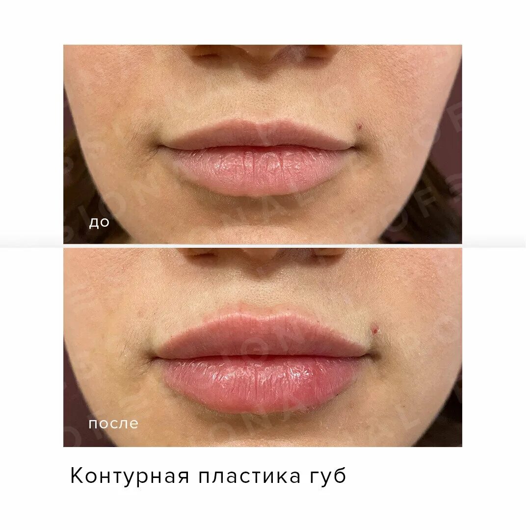 Контурные губы до и после фото. Контурной пластики губ. Губы после контурной пластики. Кон Црная пластика губ.