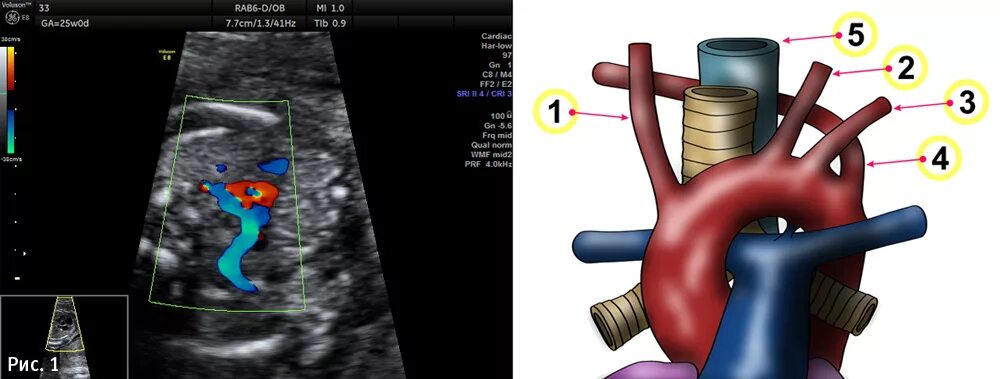 Аберрантная правая подключичная артерия кт. Аберрантная левая подключичная артерия. Правая аберрантная подключичная артерия на УЗИ. Левая аберрантная подключичная артерия у плода.