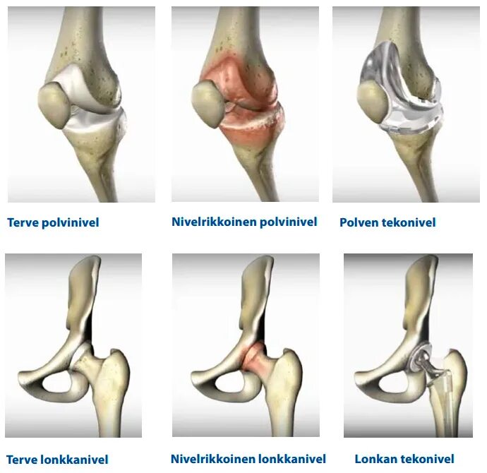 Остеоартроз 1 2 степени коленного сустава. Стадии доа тазобедренных суставов. Остеоартроз коленного суста. Деформирующий остеоартроз степени. Деформирующий остеоартроз 1 степени коленного.