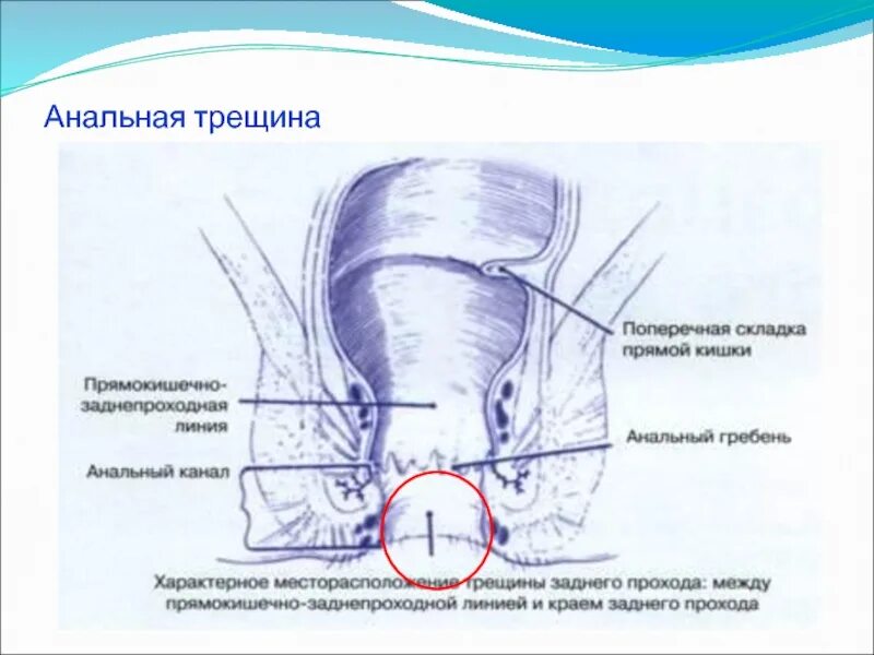 Трещина прямой. Анальная трещина (трещина заднего прохода). Анальная трещина анатомия. Поперечные складки прямой кишки. Анатомия заднего прохода мужчины.