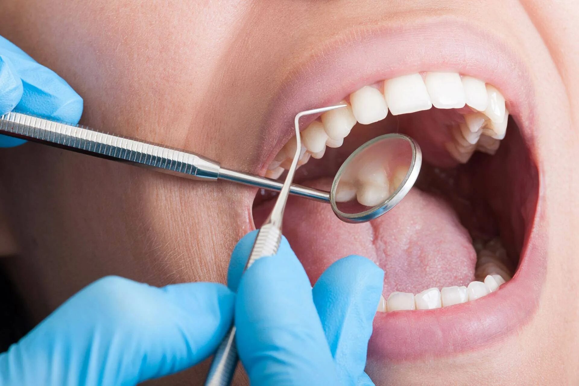 Санация полости рта это. Кариес эмали зондирование. Зубы стоматолог. Зондирование в стоматологии.