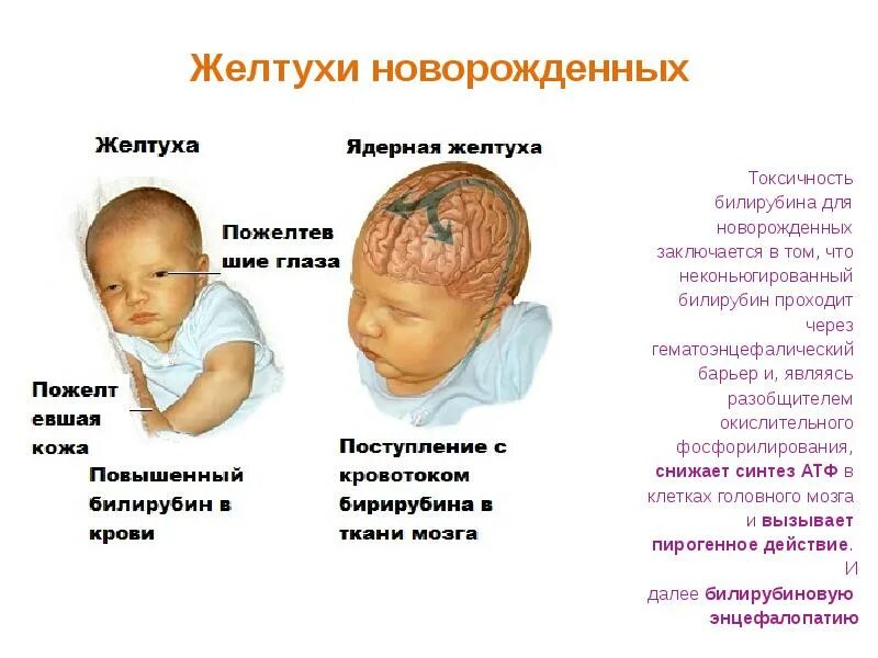 Почему появляется желтушка. Показатели при физиологической желтухе новорожденных. 256 желтушка билирубин у новорожденных. желтушка у новорожденных физиологическая и патологическая. причины физиологической желтухи новорожденных.