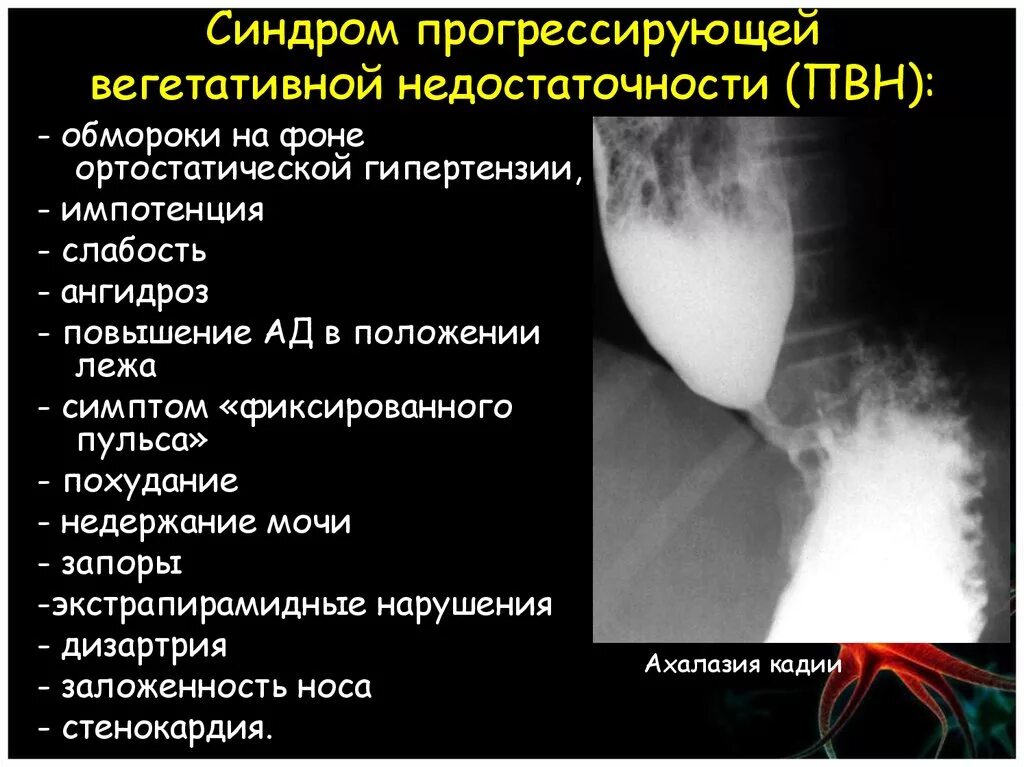 Вегетативная недостаточность. Синдром вегетативной недостаточности. Прогрессирующая вегетативная недостаточность. Синдром прогрессирующей вегетативной недостаточност. Прогрессирующей вегетативной недостаточность.