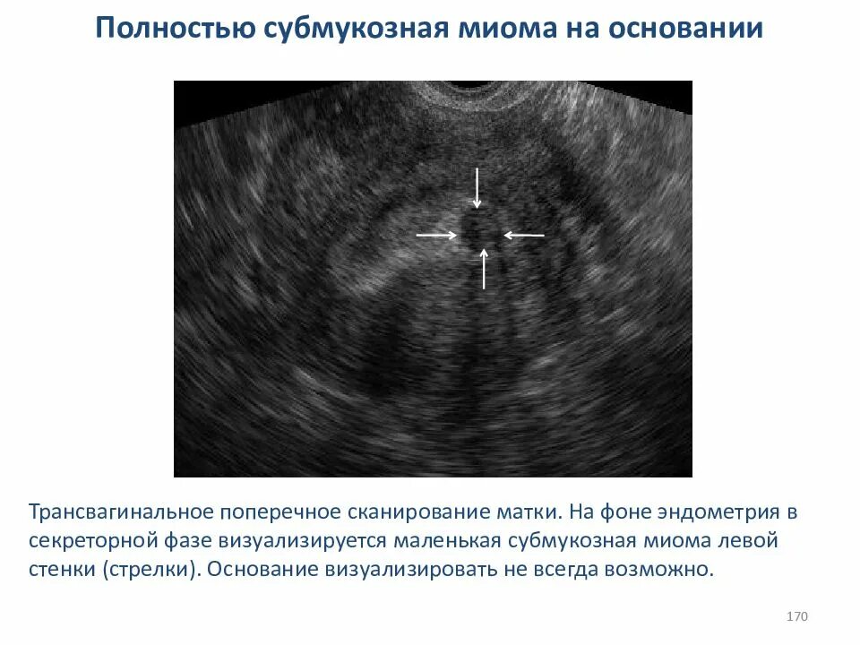 УЗИ признаки субмукозного узла. Шеечная миома матки УЗИ.