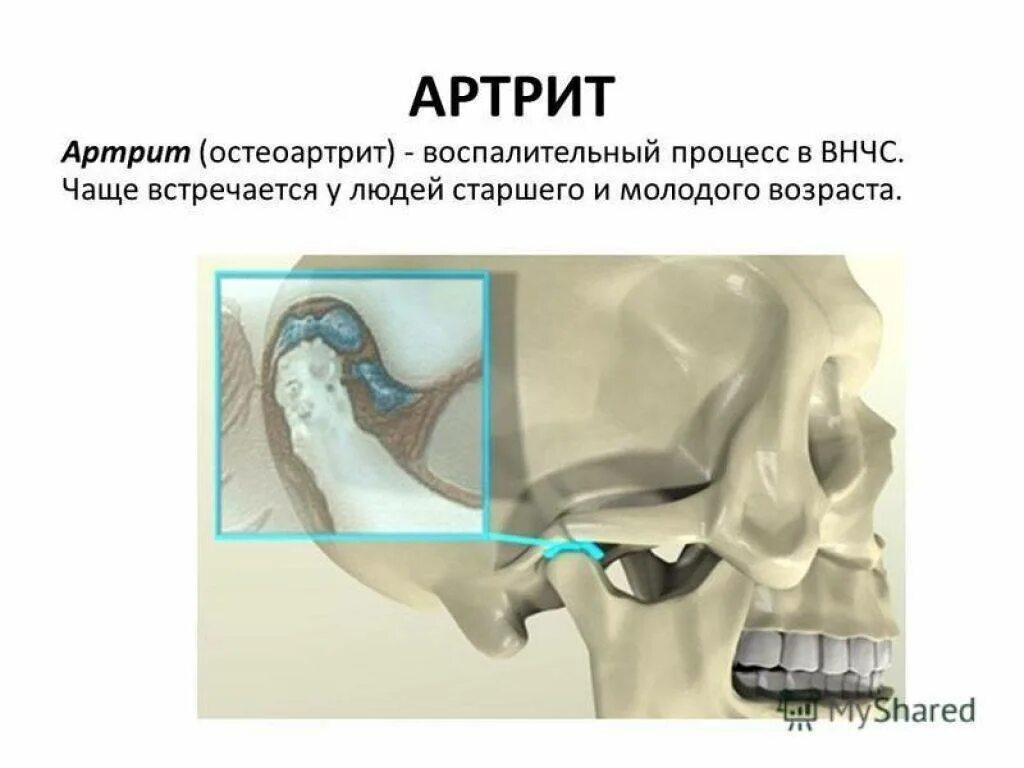 Заболевание нижней челюсти. Остеоартроз ВНЧС рентген. Артрит ВНЧС на рентгенограмме. Ревматоидный артрит ВНЧС кт.