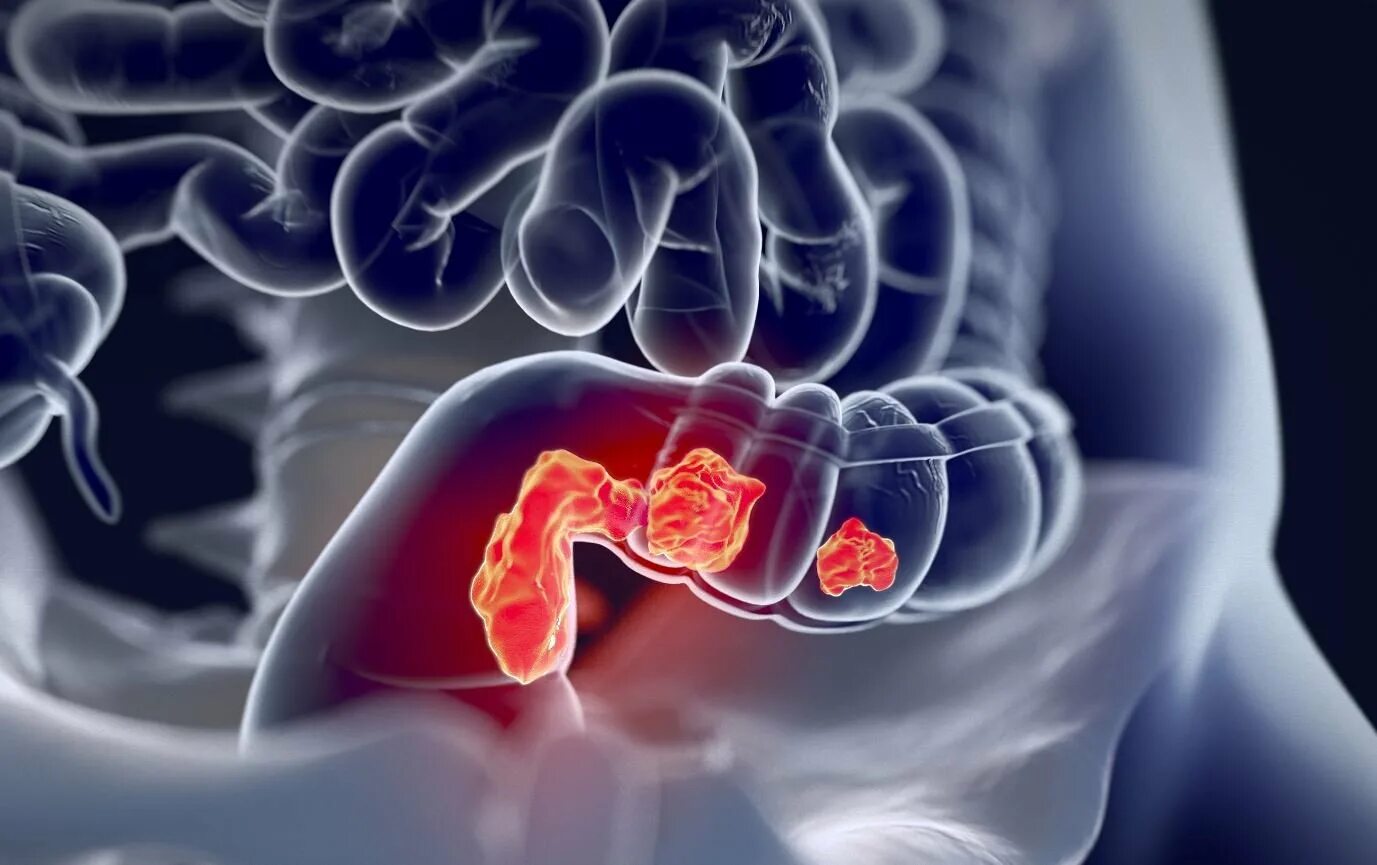 Ректальный рак. Злокачественные новообразования толстой кишки.