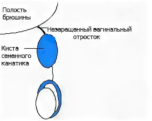 Почему у мужчины густая семенная. Киста семенного канатика гистологическое строение. Киста семенного канатика схема. Киста яичка семенного канатика. Киста канатик семенного канатика.