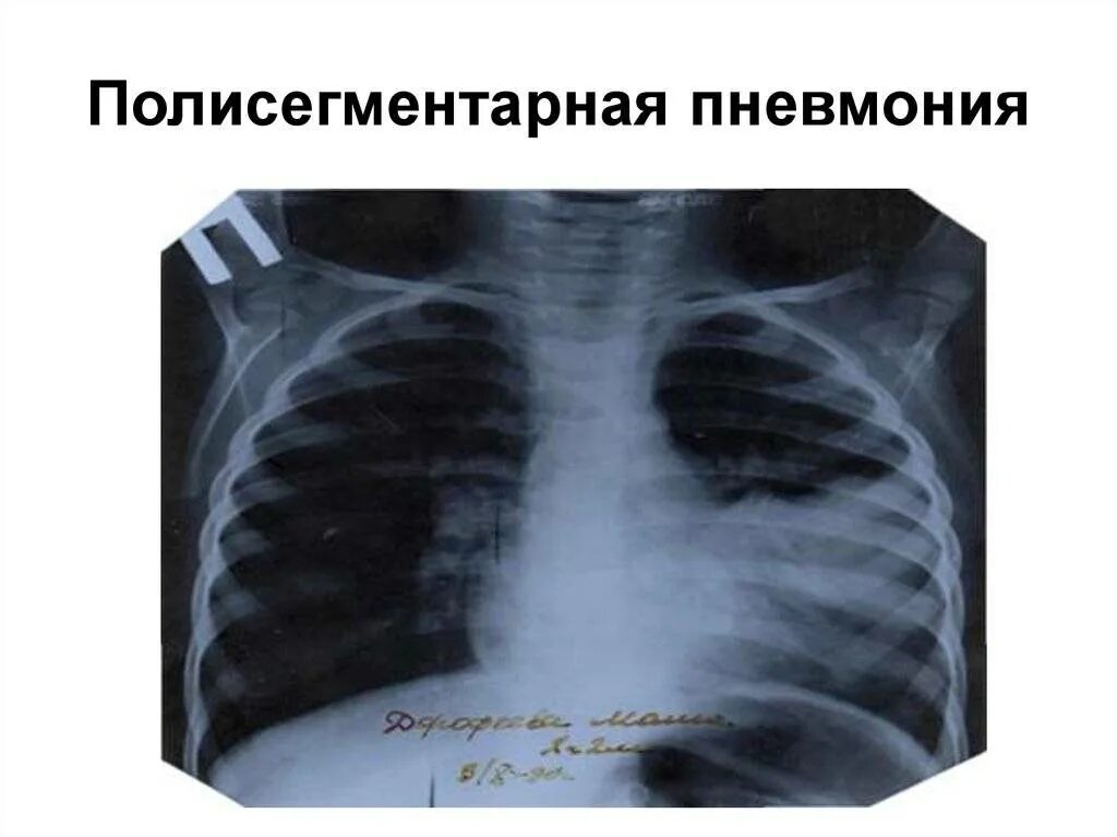 Что значит сегментарная пневмония. Левосторонняя полисегментарная пневмония рентген. рентген легких полисегментарная пневмония. полисегментарная пневмония рентген. внебольничная полисегментарная пневмония.