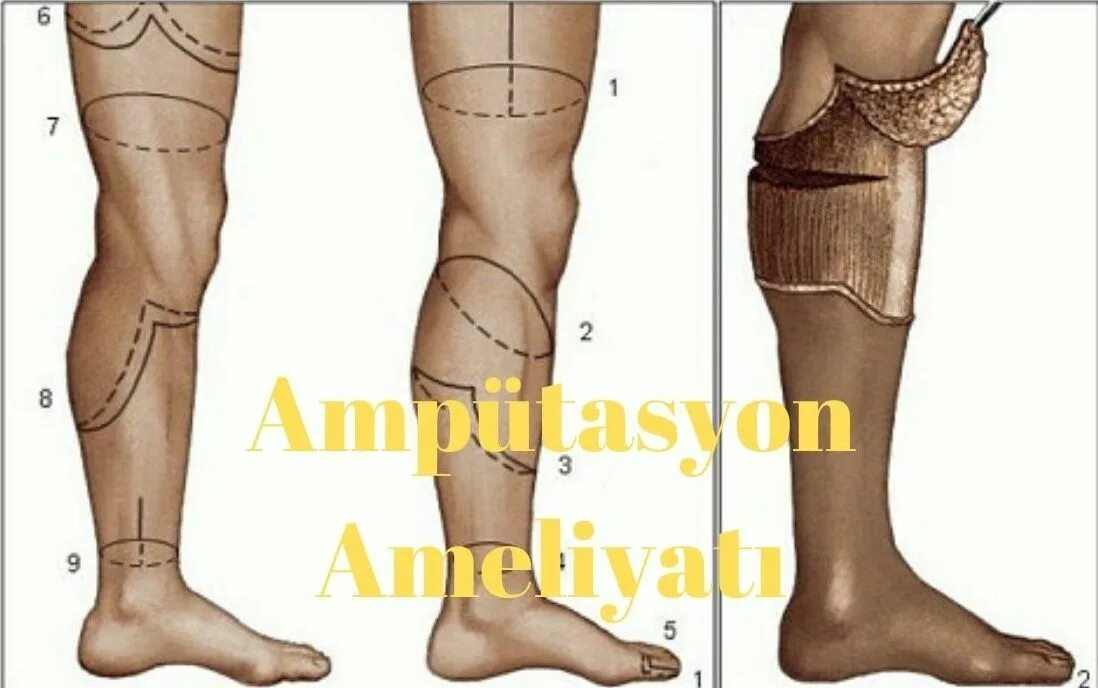 Уровни ампутации конечностей. Двухлоскутная ампутация голени. Однолоскутная ампутация голени. Реампутация культи голени.