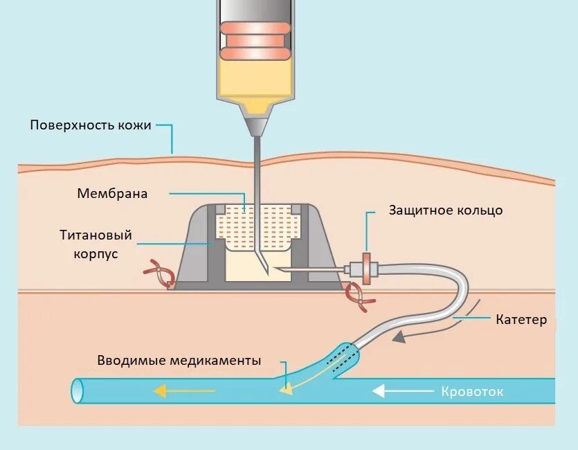 Можно ли через устройство. Устройство порт системы. имплантируемые венозные порт системы. имплантация подкожной венозной порт системы.