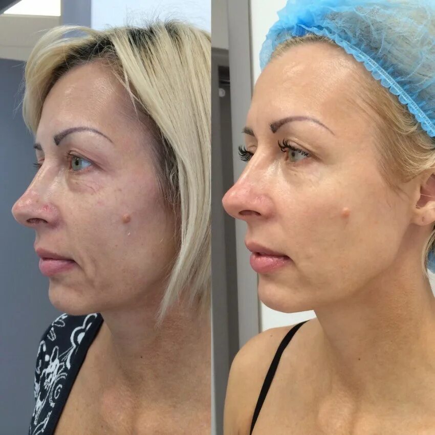 эффект удаления. заживление родинки на лице. Rf лифтинг носослезной борозды. Co2 лазер безоперационная блефаропластика. микродермабразия акне.