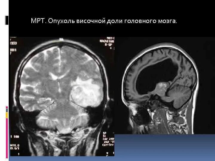 Опухоли лобной части. Опухоль лобной доли мрт. Арахноидальная киста лобной доли. Опухоль лобно-височной доли кт. Опухоль теменной доли мрт.