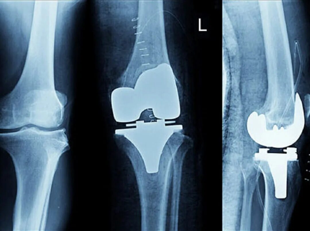 Knee XRAY. Протез коленного сустава. Рентген коленного сустава. Двустороннее эндопротезирование коленных суставов. Операции posting