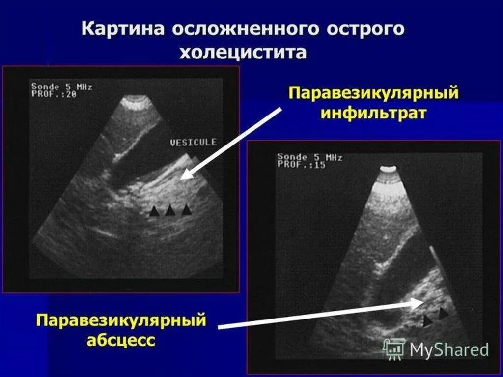 Диагноз калькулезный холецистит. Инфильтрат осложнения желчный пузырь. Околопузырный инфильтрат. Перивезикальный инфильтрат желчного пузыря. Перивезикальный абсцесс.