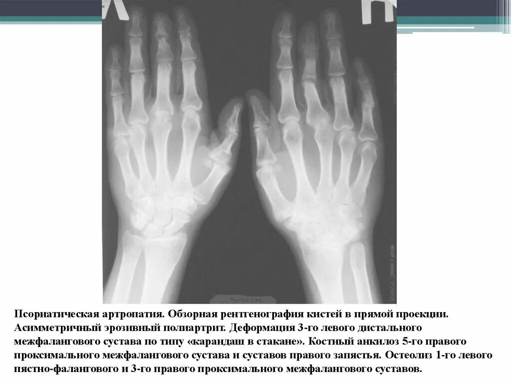 Артроз лучезапястного сустава 2 степени. Ревматоидный артрит лучезапястного сустава рентген. рентген остеоартроз межфаланговых суставов. остеоартроз кистей рентген. анкилоз лучезапястного сустава рентген.