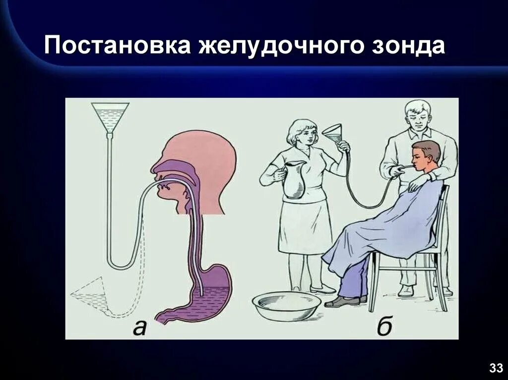 Зондовые манипуляции. Постановка желудочного зонда. Постановка зонда в желудок. Техника постановки желудочного зонда. Желудочный зонд через нос.