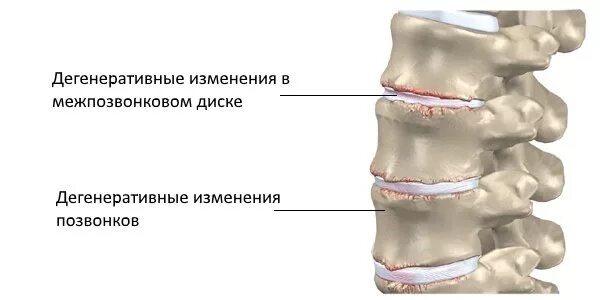 Дегенеративно-дистрофическое заболевание диска позвоночника. Дорсопатия пояснично-грудного отдела. Дорсопатия поясничного отдела позвоночника. Жистрафических извинения шейного отдела. Дистрофические изменения позвоночника лечение