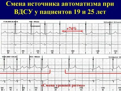Вегетативная дисфункция синусового узла