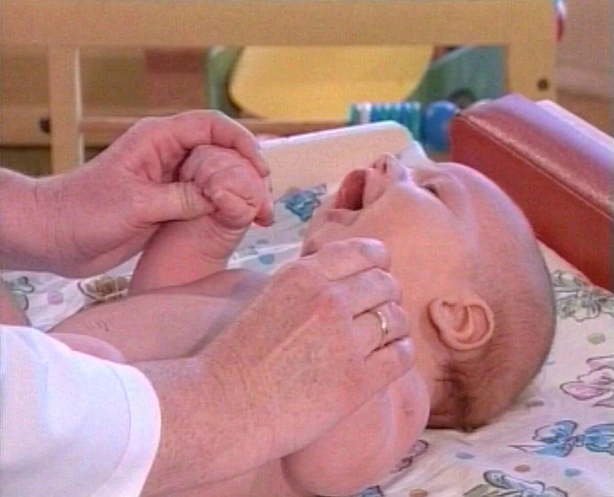 Лондоне ротовое рефлекс бобкина. Рефлексы новорожденного бабкина. Рефлексы новорожденного бабкина. Рефлекс бабкина у новорожденных. Рефлекс бабкина.