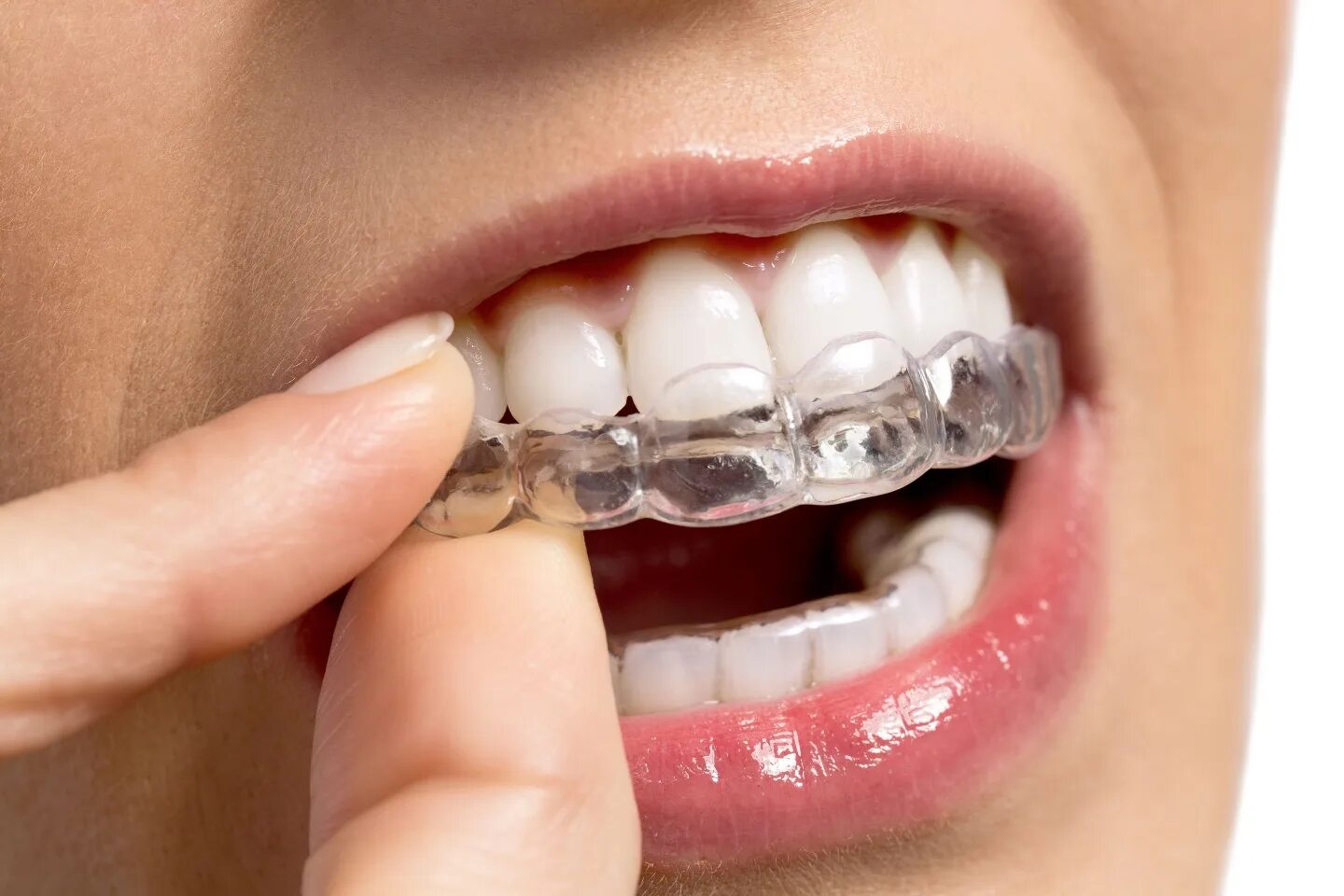 Каппы Инвизилайн. Элайнеры Invisalign. Элайнеры Инвизилайн. Ортодонтическая Капа элайнеры.