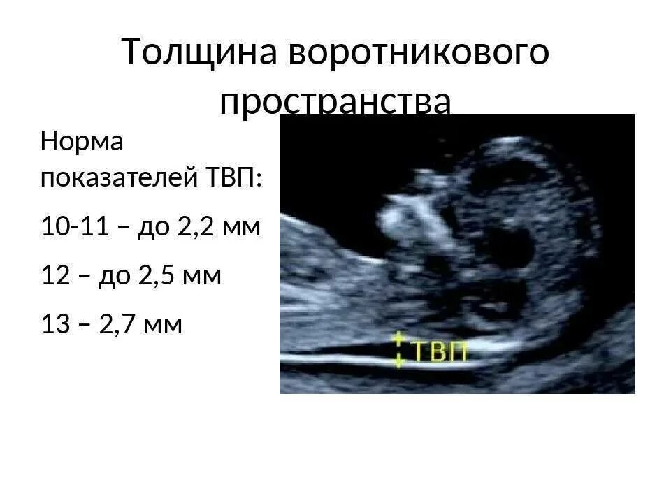 Беременность 13 мм. УЗИ норма ТВП 12 недель беременности. Толщина воротникового пространства в 14 недель норма. Толщина воротникового пространства в 12 недель норма. УЗИ 13 недель беременности показатели нормы.