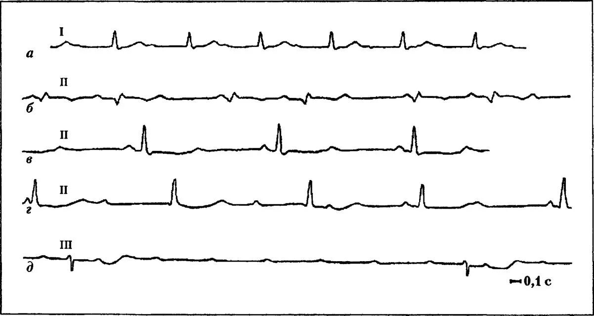 Блокада qrs. Как выглядит АВ блокада на ЭКГ. Внутрижелудочковая блокада на ЭКГ. АВ блокады сердца на ЭКГ. ЭКГ при внутрижелудочковых блокадах.