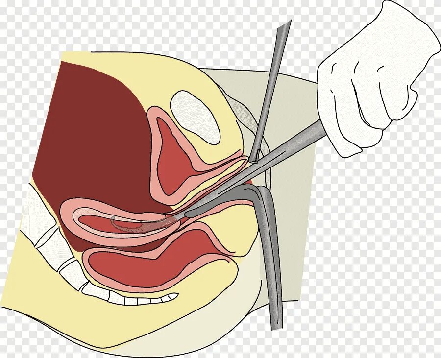 Анализ выскабливание. Выскабливание полости матки. Хирургическое выскабливание полости матки. Выскребание полости матки. Дилатация и кюретаж «выскабливание.
