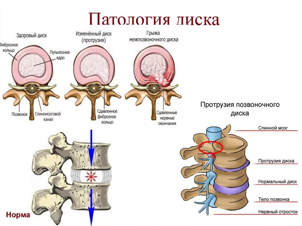 Спинные диски. Протрузия l1-l4. Грыжа /экструзия диска l4-l5 l5 l4. Позвоночная грыжа l1-l2. Протрузия l5 l6.