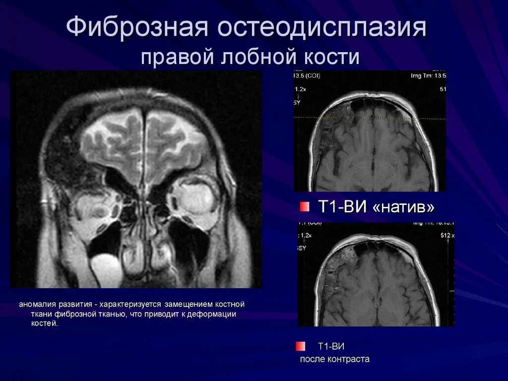 Фиброзно-кистозная дисплазия бедренной кости кт. Фиброзная дисплазия большеберцовой кости рентген. Костно фиброзные. Костно-фиброзные каналы запястья. Фиброзная дисплазия коленного сустава кт.