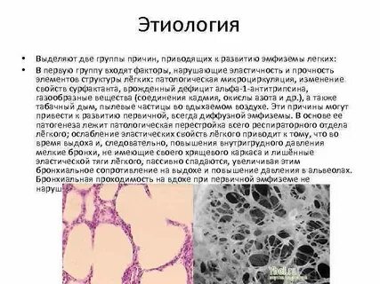 Эмфизема тканей