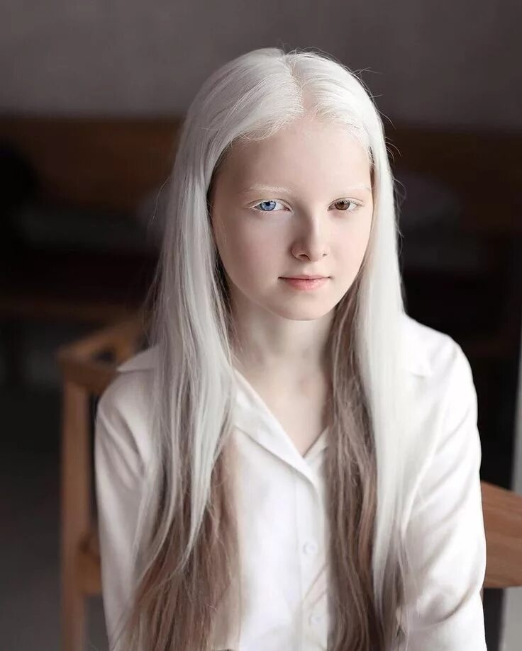 Страдающий альбинизмом