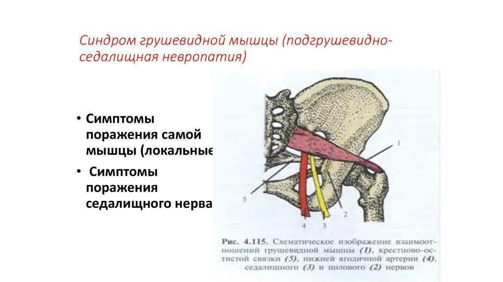 Синдром грушевидной мышцы симптомы. Синдром грушевидной мышцы симптомы упражнения. Симптомы поражения грушевидной мышцы. Защемление грушевидной мышцы симптомы. Грушевидная мышца воспаление симптомы анатомия.