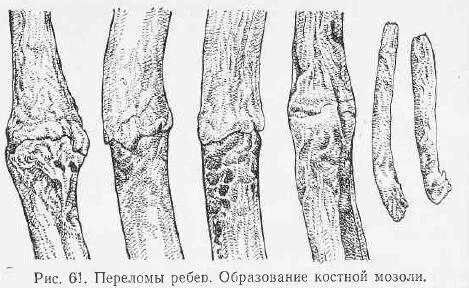 Хрящ после перелома