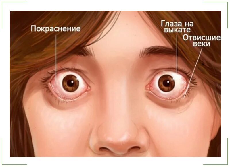 Дур глаз. Офтальмопатия Грейвса. Тиреотоксикоз экзофтальм. Эндокринная офтальмопатия.