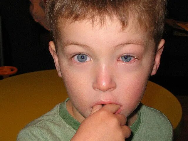 Аллергический конъюнктивит. Аллергический конъюнктивит глаза у детей.