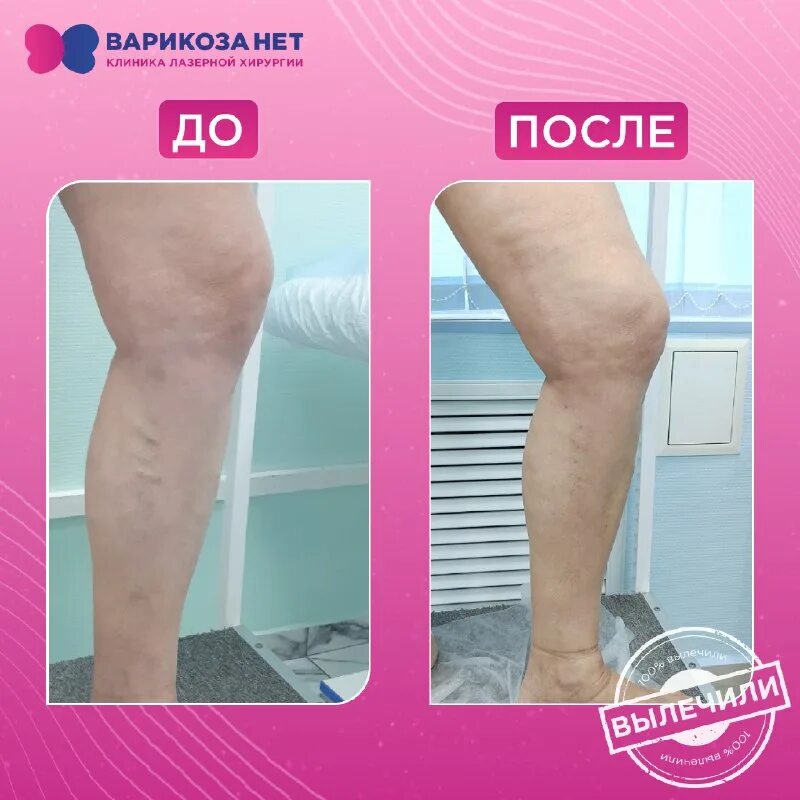 Клиника нева реклама. Клиника нева. Клиника лазерной хирургии варикоза. Лого для флеболога. Компрессионный трикотаж реклама.