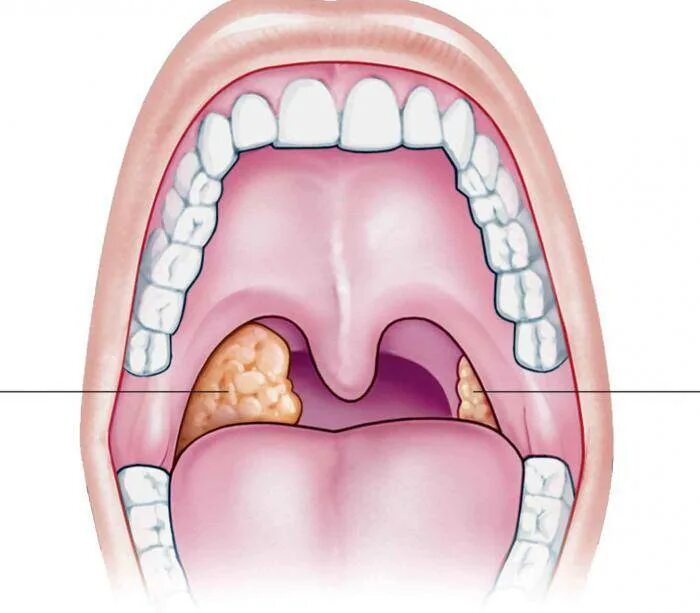 Болит рот форум. Миндалины ротовой полости. Небные миндалины тонзиллит.